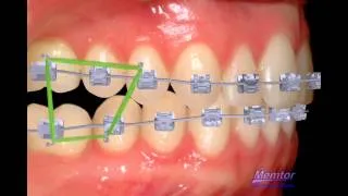 Rubber band to correct posterior open bite-orthodontist