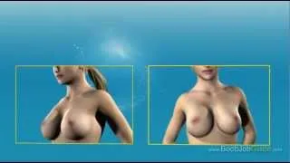 Boob Job (or Augmentation Mammaplasty)