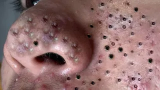 Make your Acne Treatment | Acne  spa 50 |  Best Videos Ever