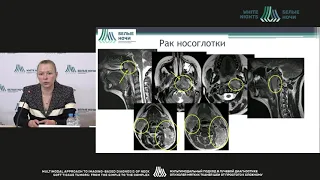 МР-томография в дифференциальной диаг-ке опухолевых и восп.пораж. миндалин лимфоидного глоточ.кольца
