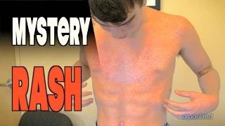 MYSTERY RASH After Strep Throat & Antibiotics: LIVE DIAGNOSIS with Dr. Paul