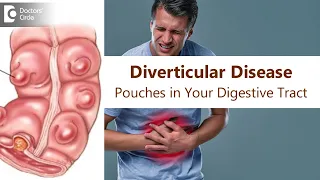 Diverticular Disease| Intestinal Pouch | Cause, Symptom, Treatment-Dr.Rajasekhar MR |Doctors' Circle