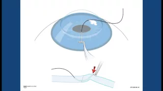 Corneal Suturing, Part 4 - Bringing the Needle to the Host Surface