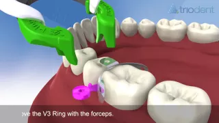 Triodent V3 Sectional Matrix System Animation (Sub-Titles)