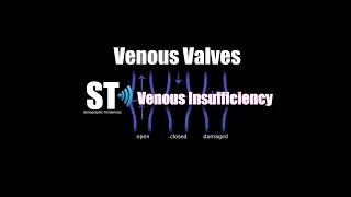 Venous Insufficiency