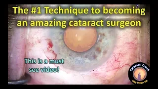 The #1 Technique to becoming an amazing cataract surgeon