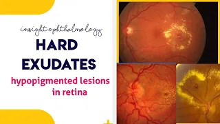 HARD EXUDATES || Hypopigmented lesions of the retina ||