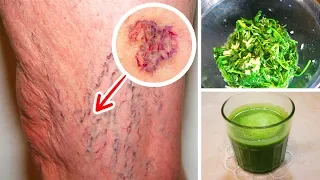 I Thought Spider Veins Were My Curse, Until I Tried This Juice!