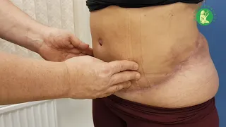 Юлия - 2 месяца после абдоминопластики