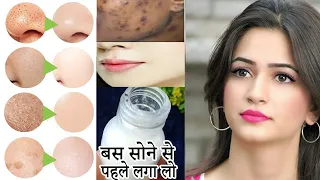 सोने से पहले बस ये लागो सिर्फ 3 दिन में दाग धब्बे जड़ से ख़त्म Remove Dark Spots On Face Acne Fairskin