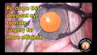 Re-draping the eye makes cataract surgery more efficient