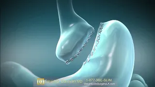 Gastric Bypass Bariatric Surgery Animation