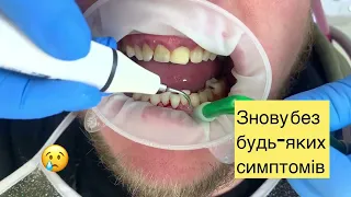 зубной камень удаление, удалить зубной камень, цена удалить зубной камень поддесневой зубной камень