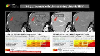 12. Pitfalls in Cirrhosis Imaging and User Errors in applying LI-RADS - Part 2. Dr. Khaled Elsayes