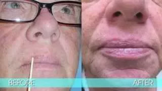 EXCISION OF BASAL-CELL CARCINOMA OF THE LIP - DR. TANVEER JANJUA - NEW JERSEY