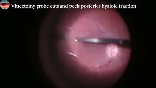 Vitrectomy Surgery for Vitreomacular Traction Syndrome