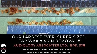 OUR LARGEST EVER SUPER SIZED EAR WAX & SKIN REMOVAL - EP 338