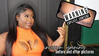 😭 OMGG My Surgery Incision Opened | Pictures Included | Breast Reduction Journey