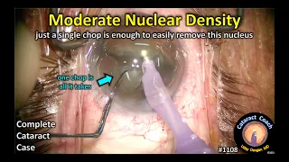 CataractCoach 1108: moderate nuclear density only needs a single chop