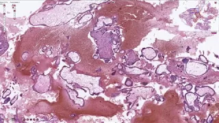 Products of Conception - Histopathology