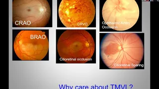 Mark Dinkin, MD. Transient Vision Loss.