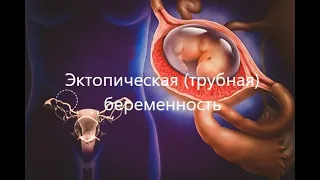 Прогрессирующая трубная беременность 5 недель 6 дней. Классика.