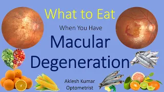 What to Eat When You Have Macular Degeneration | ARMD | Wet ARMD | Dry ARMD