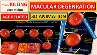 age related macular degeneration - wet vs dry macular degeneration - vision loss due to wet ARMD