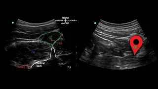 Quadratus Lumborum (QL) block: Ultrasound identification