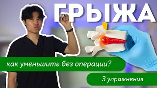 Как уменьшить грыжу без операции? Выполняй 3 упражнения