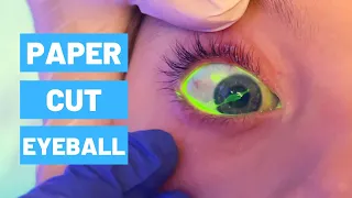 Paper Cut on Eyeball - Viewer Discrection