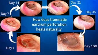 How does traumatic eardrum perforation heals?