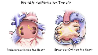 Hybrid AF Therapy Option