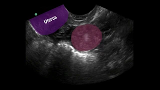 POCUS: 1st Trimester Pregnancy Case 4 - Ectopic Pregnancy