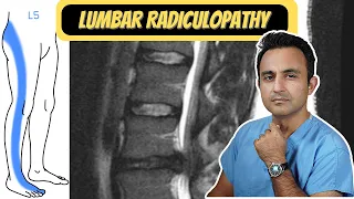 Lumbar Radiculopathy ("Sciatica"): What you need to know.