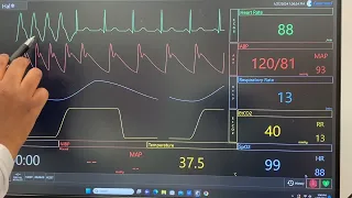 Analyzing Ventricular ECG Rhythms: PVC, VT runs, Ventricular Tachycardia, Right BBB, Torsades