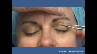 Tutorial - Marking the Upper Lid Blepharoplasty