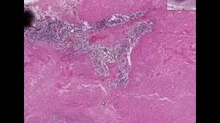 Histopathology Testis-- Embryonal carcinoma