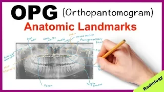 Orthopantomogram (OPG) Anatomical Landmarks - Radiology