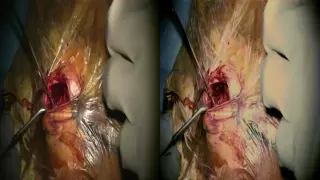 Combined Endoscopic and Open Approach for Resection of Orbital Roof Meningioma