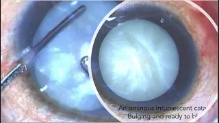 PRESSURE POINTS IN THE MANAGEMENT OF INTUMESCENT CATARACTS