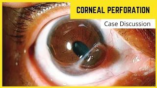 Ophthalmic Emergency || Corneal Perforation || Case discussion