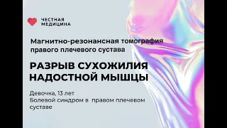 МРТ правого плечевого сустава «Разрыв сухожилия надостной мышцы» от компании Честная Медицина