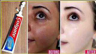 Apply Toothpaste on Your Skin and See Magical Result within 1 Hour | Amazing Toothpaste Beauty Hacks