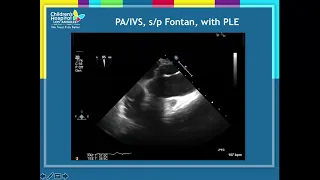 How to secure an embolized PA stent