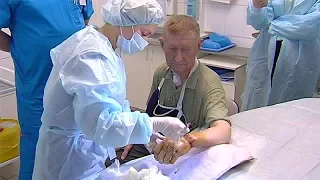 Пермские врачи пришили мужчине руку, отрубленную топором