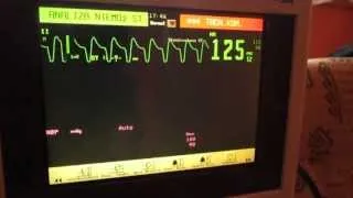 EKG Monitor