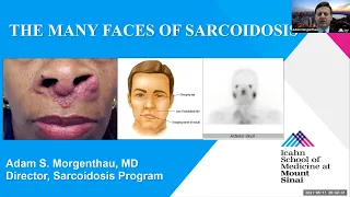 The Many Faces of Sarcoidosis