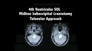 4th Ventricular SOL, Telovelar Approach