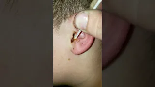 Extreme earwax cleaning!